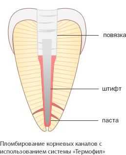 пломбирование корневого канала с использованием системы Термофил