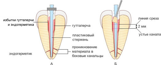 пломбирование корневого канала методом термофил