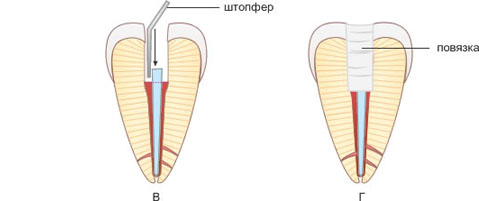 пломбирование корневого канала методом термофил