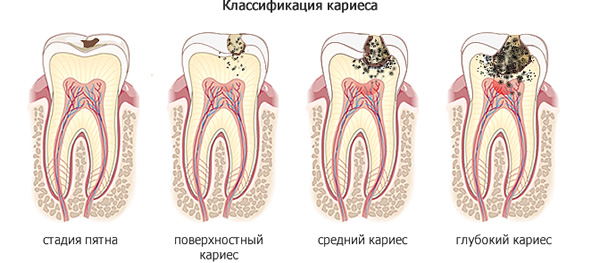 Стадии развития кариеса