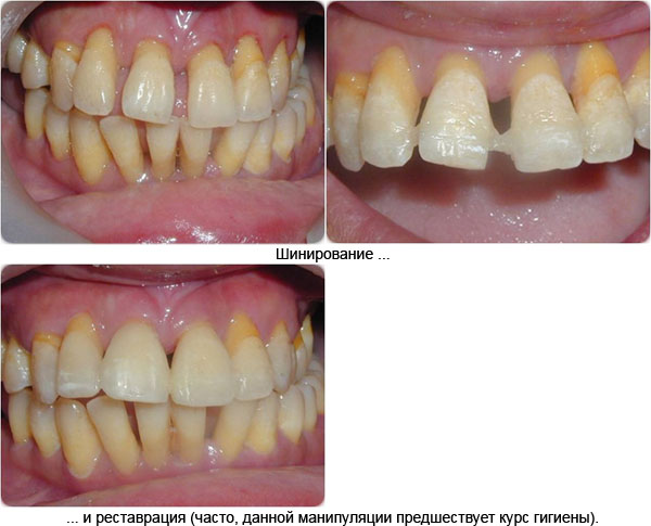 Шинирование и реставрация при расшатанности зубов