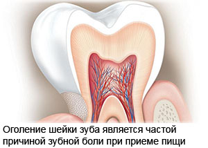 Обнажение корня зуба является частой причиной повышенной чувствительности зубов