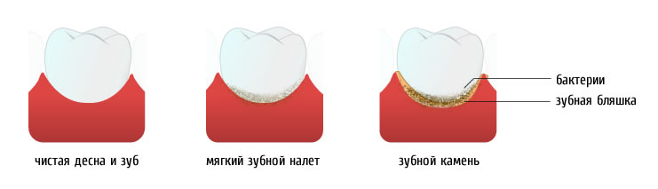 Как образуется зубной камень