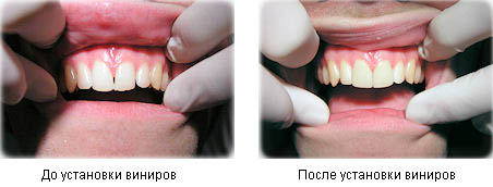 виниры до и после 1й случай