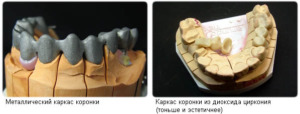 Отличия каркаса из диоксида циркония от металлического